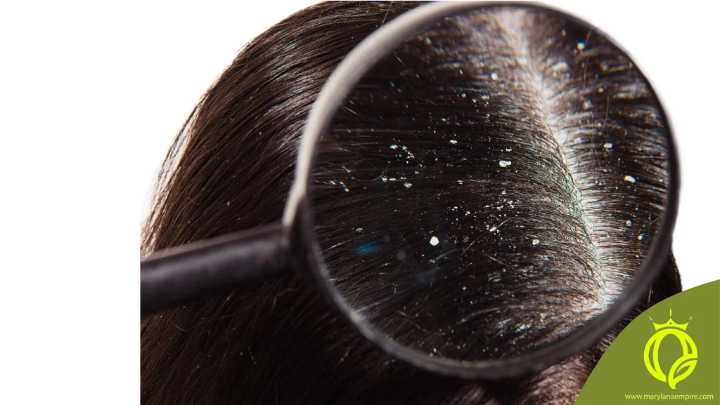 رفع شوره سر/ درمان شوره سر/ مراقبت از مو